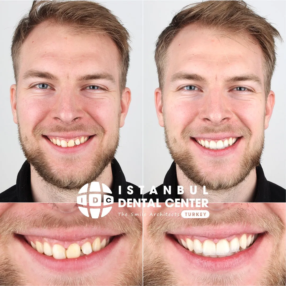 Before and after treatment at Istanbul Dental Center