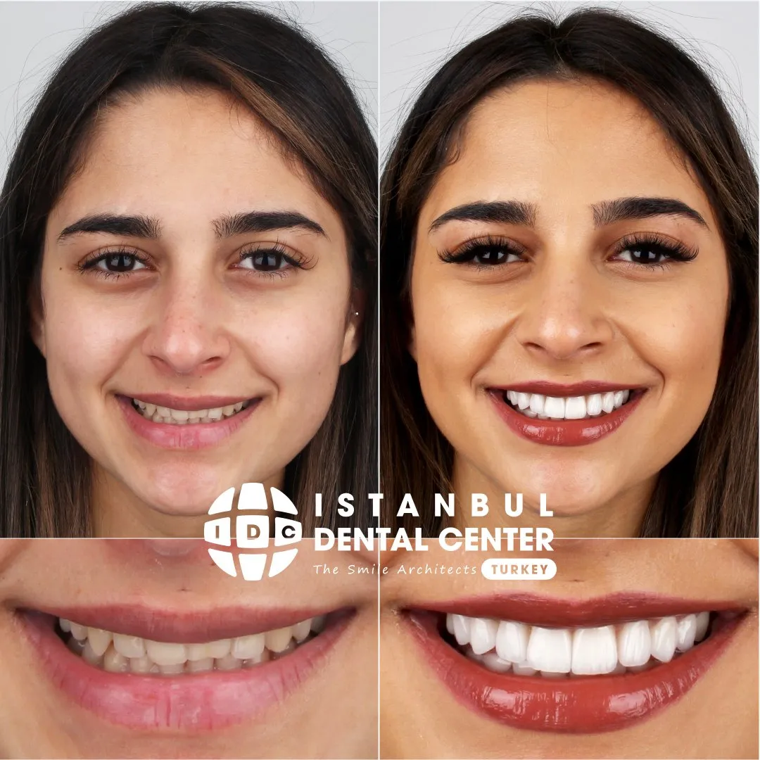 Before and after treatment at Istanbul Dental Center
