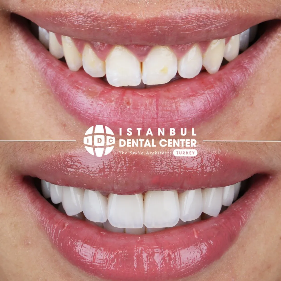 Before and after treatment at Istanbul Dental Center