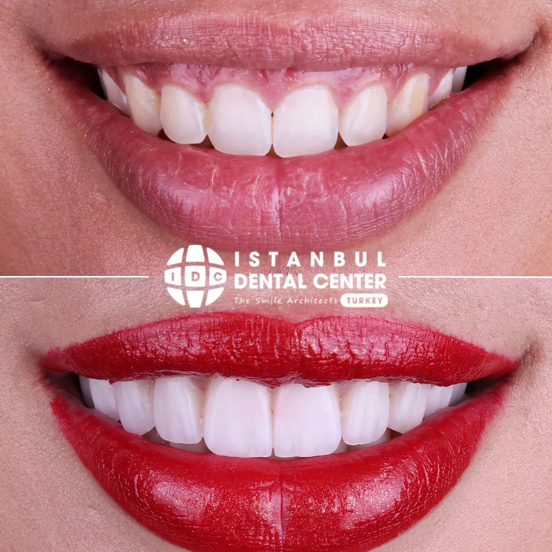 Before and after treatment at Istanbul Dental Center
